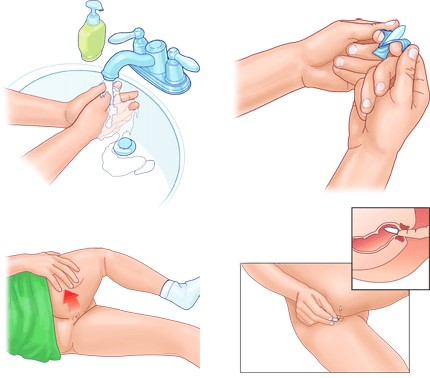 Insertion Of Suppository